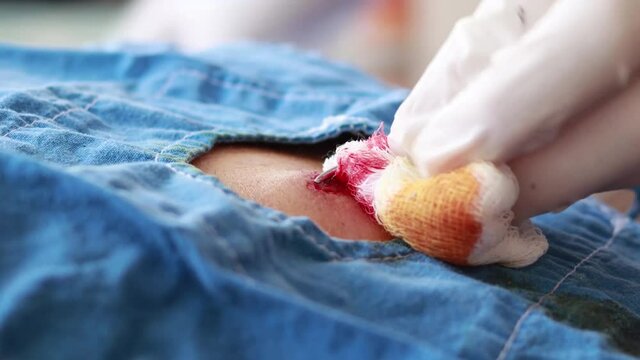 Cutting skin in man's back for ambulatory surgery in selective focus