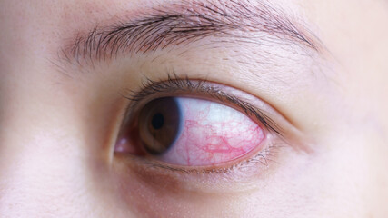 Obraz premium Red bloodshot eye of woman, irritated or infected, conjunctivitis eye or after cry.