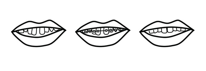 Illustration of esthetic dentistry and orthodontics. Braces teeth step illustration vector isolated on a white background. Distorted, beautiful tooth arrangement, with metal bracket. Doodle style.