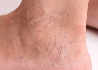 Varicose veins on the leg of a woman. Varicose veins on the leg close-up.