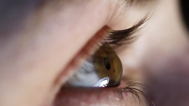 Macro eye, cornea. Ophthalmic disease - keratoconus. Corneal transplant, cross-linking.