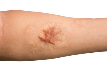 Close up Keloid scar (Hypertrophic Scar) on man arm skin after accident isolated on white background.