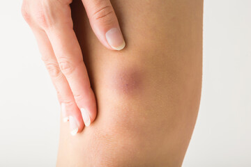 Young woman hand touching her leg isolated on light gray background. Bruise on knee. Medical...