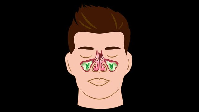 Sinusitis inflammation HD alpha channel