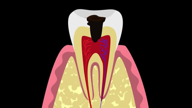 Tooth decay, dental caries and inflammation of the nerve of the tooth, pulpitis, HD alpha channel