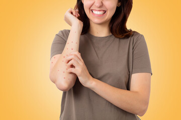 Scabies. Close up portrait of a Caucasian young woman scratching her hand covered in a red rash....