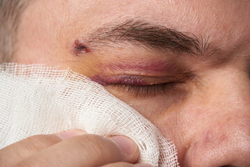 close view of a black eye, man's face with a hematoma