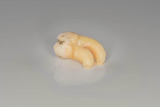 A closeup of a sectioning right lower third molar with curved root. (Adult tooth number 48)
