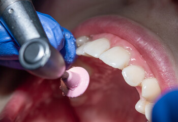 Examination and treatment of anterior teeth by a dentist, special plates for polishing teeth after...