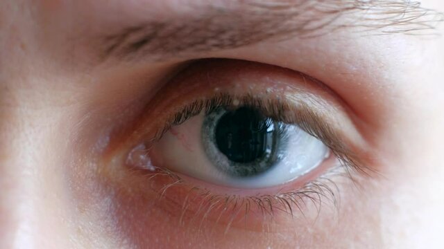 Macro footage - girl opens eye, her pupil is large due to taking drugs or medication. 4k. Eye after medical drops a visit to an ophthalmologist.