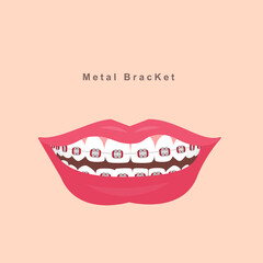 smile with metal bracket.