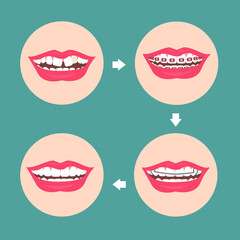 Wisdom tooth  illustration Vector.