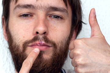 Lower part of beard man's face with herpes on his lips and hand putting cream on it with thumbs up. concept of treatment for herpes