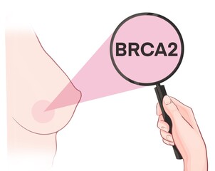 Variants in the BRCA2 gene are associated with an increased risk of developing breast cancer