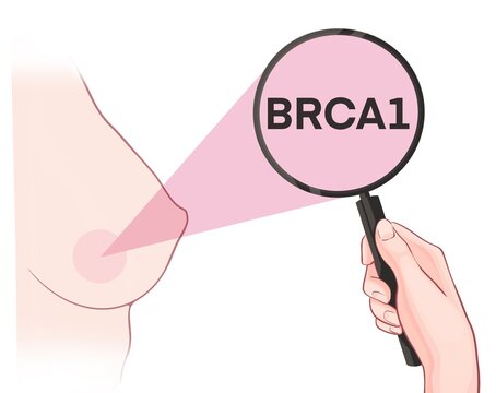Variants in the BRCA1 gene are associated with an increased risk of developing breast cancer