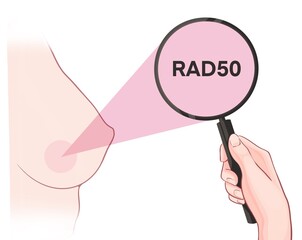 Variants in the RAD50 gene are associated with an increased risk of developing breast cancer