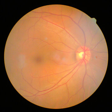 Retinal