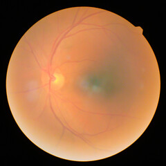 retinal