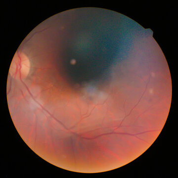 Retinal