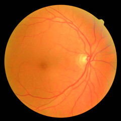 retinal
