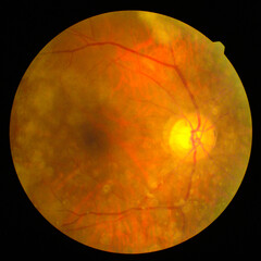 retinal