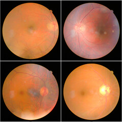 retinal images