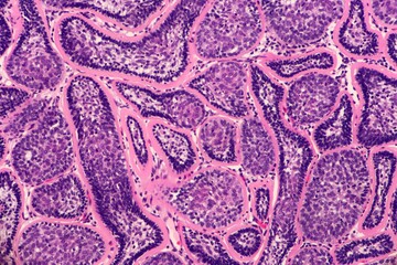 Dermal cylindroma, a benign skin tumor with Nests of two cell populations surrounded by a thickened...