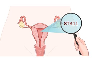 Variants in the STK11 gene are associated with an increased risk of developing endometrial cancer