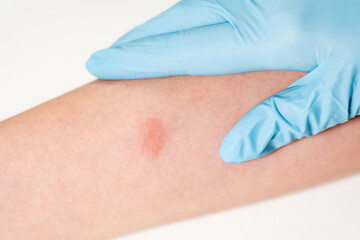 Closeup view photography of kids hand with red spot reaction to conducting Mantoux test after 72 hours from injection. Hand of nurse or doctor wearing blue glove. © Andrii Oleksiienko
