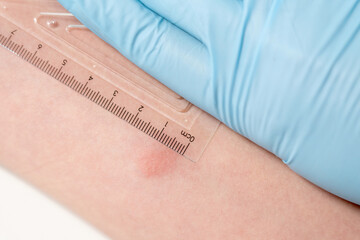 Closeup view photography of child's hand with red spot reaction to conducting Mantoux test after 72 hours from injection. Nurse in blue gloves applying transparent ruler to check reaction.