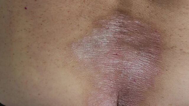 psoriasis: a close-up of a man running his hand over an area of the back affected by psoriatic rashes and plaques