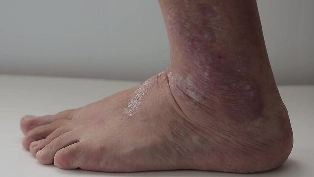 Psoriasis. A man combs the area of the foot affected by psoriatic plaques