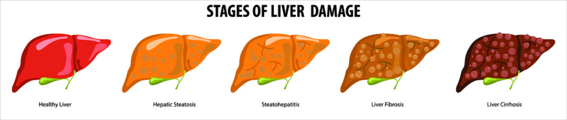 Stages of liver damage. Liver Disease. Healthy, fatty, liver fibrosis and Cirrhosis. Illustration isolated on white background.