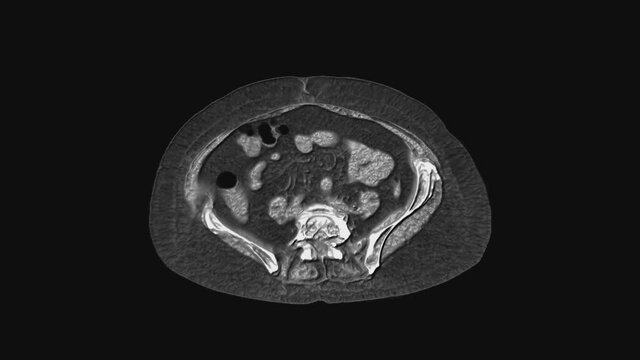 Voluminous MRI of the abdominal cavity, gastrointestinal tract, bladder