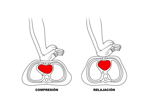 Compresi&oacute;n Relajaci&oacute;n - RCP Reanimaci&oacute;n Cardiopulmonar