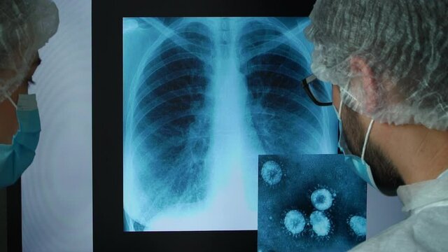 Team of doctors scientists at computer monitor in clinic discuss x-ray of patient with lung pneumonia caused by coronavirus. COVID-19