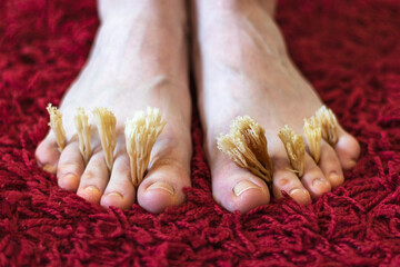 Coral fungus between the toes of female feet. The concept of fungal skin diseases.