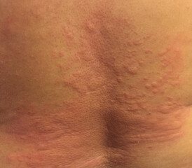 Severe hives from allergic reaction 