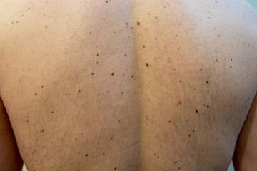 Fototapeta premium men's back in moles, doctor's examination photo