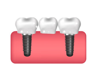 Dental implants, bridge construction, prosthetics 3D realistic style. Dentistry, healthy teeth concept. Vector illustration