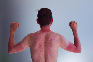 The guy burned in sun in city, the silhouette of t-shirt and watch. Reddened with acne skin on hands and neck-sunburn. cause of melanoma. He has a burning pain on his shoulder.