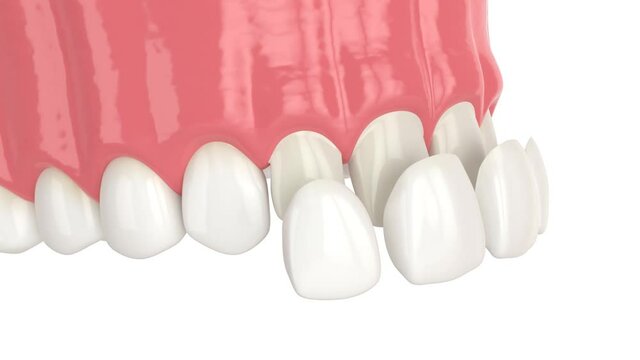 Upper jaw with installed dental veneers over white background