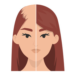 Hair transplantation before and after vector isolated. Alopecia treatment, forget about baldness. Hairless woman.