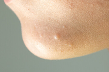 Close-up of Molluscum Contagiosum also called water wart. Viral formations in the chin on the skin...