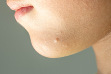 Close-up of Molluscum Contagiosum also called water wart. Viral formations in the chin on the skin...