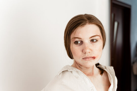 close-up portrait of a girl who has become a victim of domestic violence, stands on a white background, looks at the camera, a girl with freckles