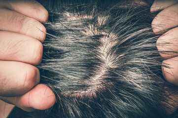 Fototapeta Closeup view of hair of a man with dandruff obraz