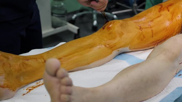 Cleaning and preparation of the leg skin before surgery with iodine solution.