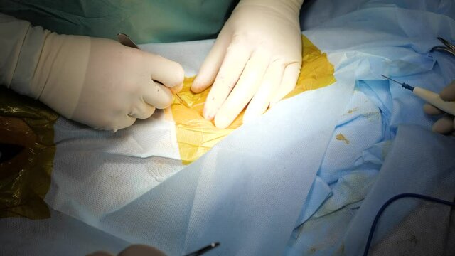 Surgeon's hands in sterile gloves performing operation with surgery tools. Surgeon makes first incision during the surgery.
