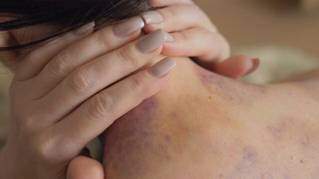 Close-up of a bruise on a woman's shoulder. Domestic violence.